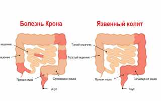 Температура при колите