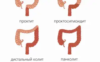 Умеренно выраженый колит