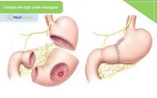 Реабилитация после рака желудка