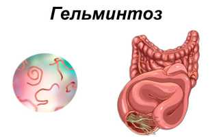 Как бороться с глистами, (гельминтами, гельминтозами) у человека в домашних условиях?
