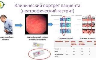 Щелочной рефлюкс-гастрит
