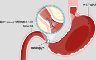 Как лечить дуоденит гастральный рефлюкс