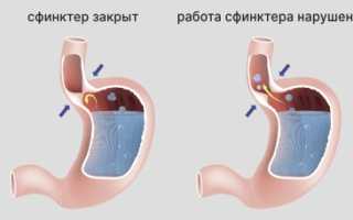 Фибринозный рефлюкс-эзофагит