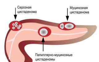 Аденома (цистаденома) поджелудочной железы (серозная, муцинозная)