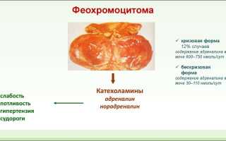 Симптомы и признаки феохромоцитомы