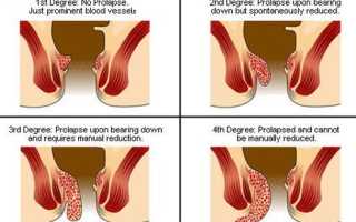 Как быстро облегчить геморрой?