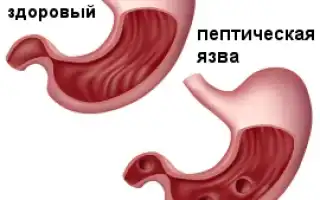 Пептическая язва желудка:  ее симптомы и лечение