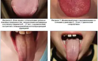 Язык при гастрите